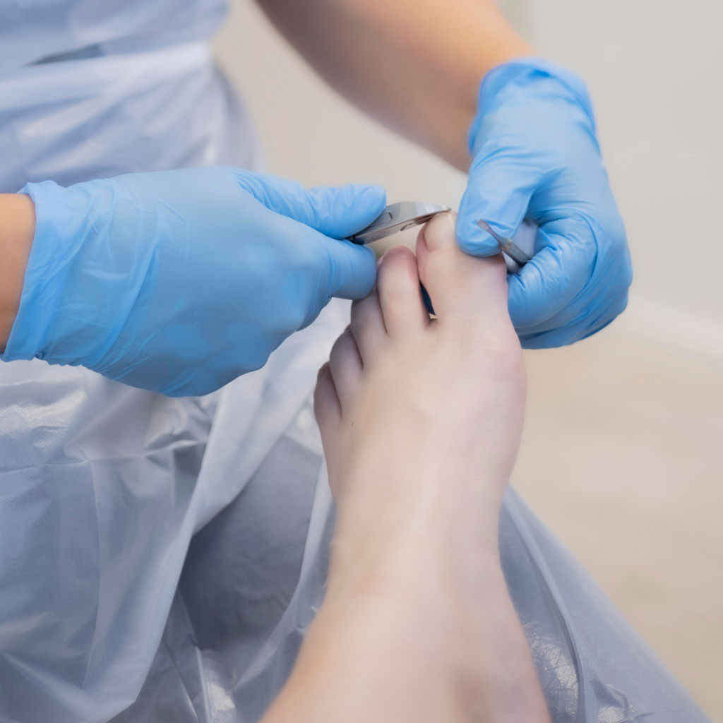 Kynnen oikaisuhoito.